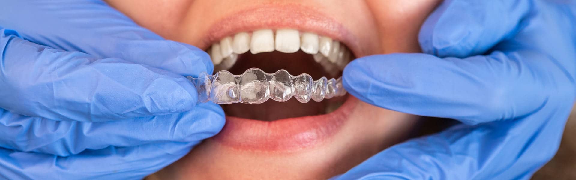 The Ultimate Guide to Invisalign Braces: Pros and Cons Uncovered